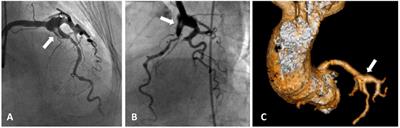 Frontiers | Coronary Artery Aneurysms: A Review Of The Epidemiology ...